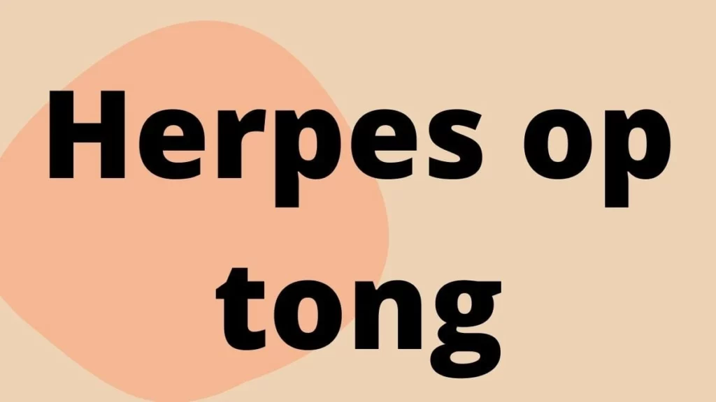 Herpes op tong