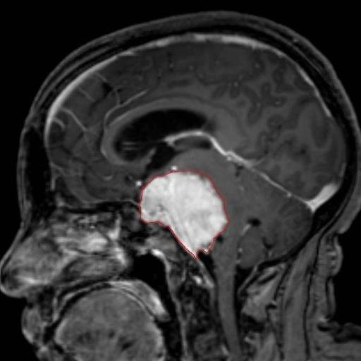 Wat is een tumor in hoofd?